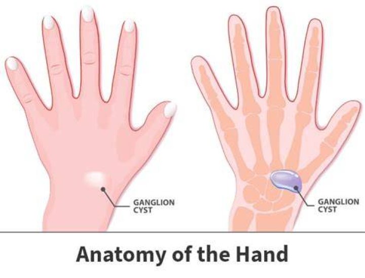 How do you treat a ganglion cyst on hand?