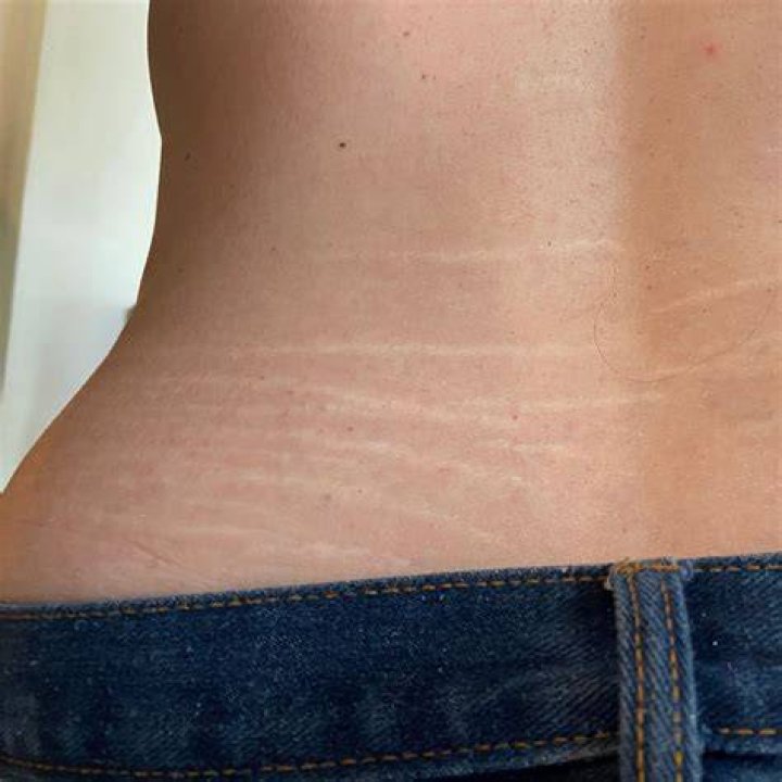 Why do I have stretch marks on my back when I'm skinny?